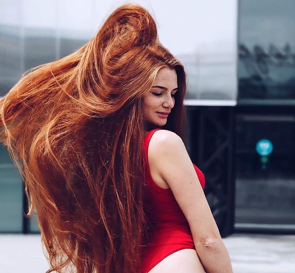 alopecia_redhead.jpg