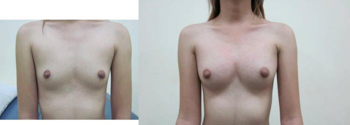 best_breast_augmentation_implants_surgeon_in_the_world_cambodia_025.jpg
