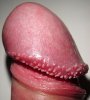 230px-Hirsuties_papillaris_coronae_glandis.jpg