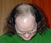 220px-Male_pattern_baldness.jpg